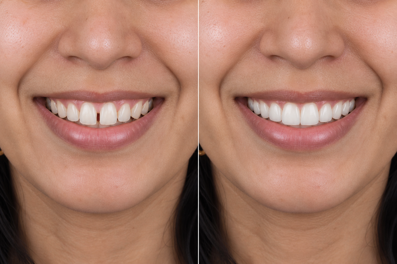 Representative smile alignment result